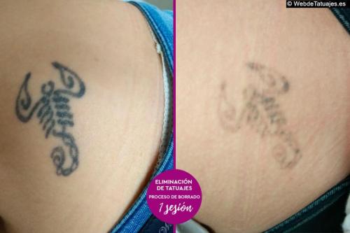 Eliminación de Tatuajes en Galicia