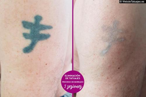 Eliminación de Tatuajes en Galicia